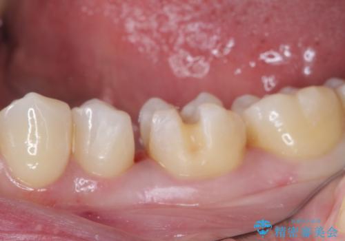 銀歯をセラミックにしたい セラミックインレー修復の治療中