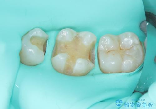 銀歯をセラミックにしたい　セラミックインレー修復の治療中
