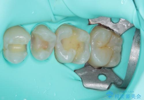 銀歯をセラミックにしたい　セラミックインレー修復の治療中