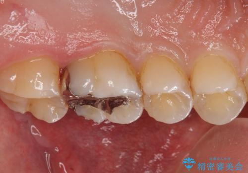 ジルコニアクラウン治療の治療前