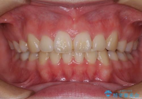目立たない装置で出っ歯を治したい ハーフリンガル矯正の症例 治療後