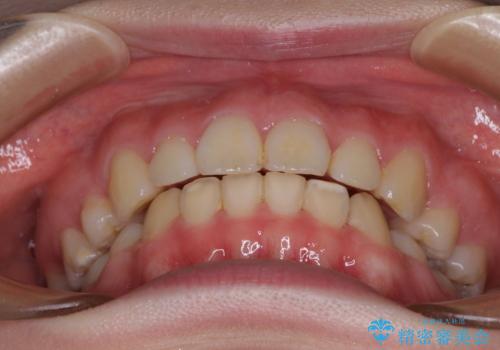 目立たない装置で出っ歯を治したい ハーフリンガル矯正の治療後