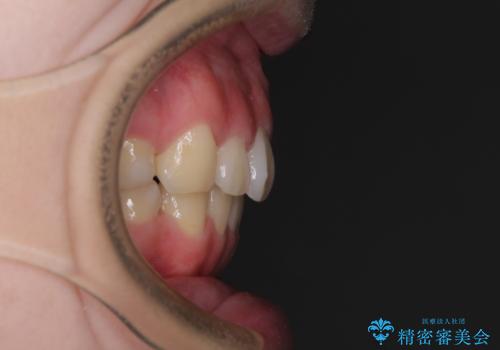 目立たない装置で出っ歯を治したい ハーフリンガル矯正の治療後