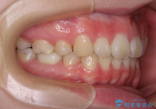 目立たない装置で出っ歯を治したい ハーフリンガル矯正の治療後