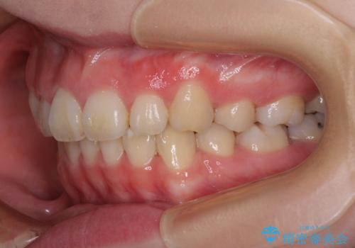 目立たない装置で出っ歯を治したい ハーフリンガル矯正の治療後