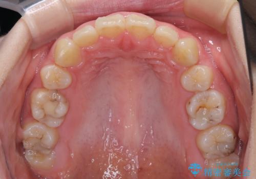 目立たない装置で出っ歯を治したい ハーフリンガル矯正の治療後