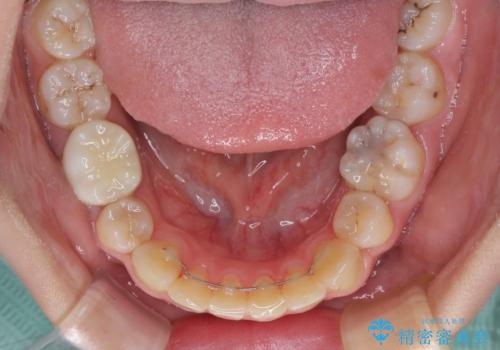 目立たない装置で出っ歯を治したい ハーフリンガル矯正の治療後