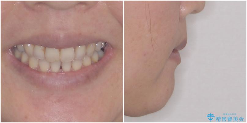 閉じにく口元と欠損歯列　ワイヤー装置の抜歯矯正の治療後（顔貌）