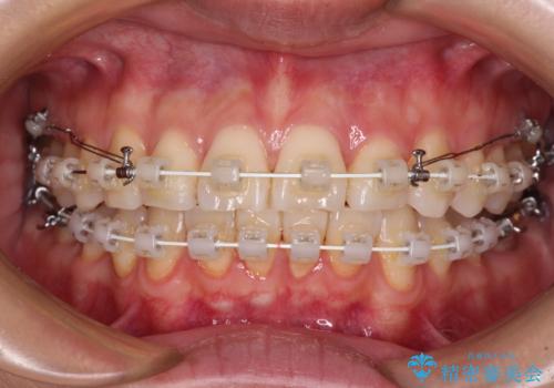 前にずれた咬み合わせをワイヤー装置でしっかりと改善の治療中