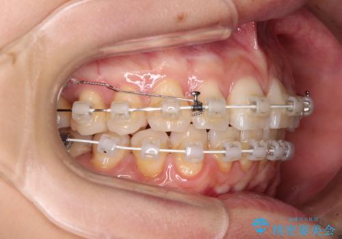 前にずれた咬み合わせをワイヤー装置でしっかりと改善の治療中