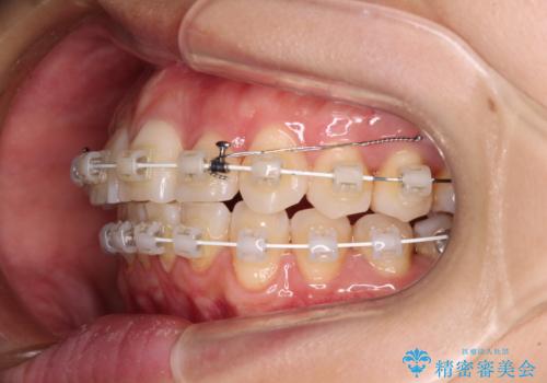 前にずれた咬み合わせをワイヤー装置でしっかりと改善の治療中
