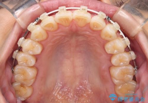 前にずれた咬み合わせをワイヤー装置でしっかりと改善の治療中