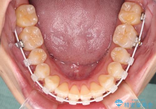 前にずれた咬み合わせをワイヤー装置でしっかりと改善の治療中
