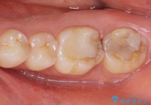 歯が黒くて虫歯じゃないかと心配して来院