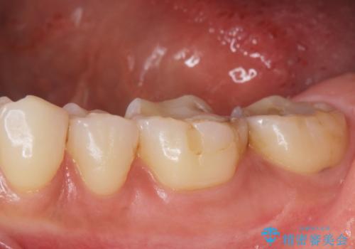 歯が黒くて虫歯じゃないかと心配して来院の治療前