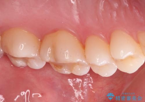 検診で虫歯を発見。の治療前