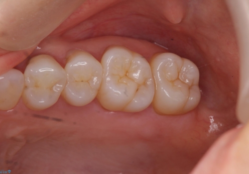奥歯の深くて確認しにくい虫歯　ゴールドインレーでの治療の治療前