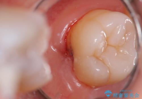 奥歯の深くて確認しにくい虫歯　ゴールドインレーでの治療の治療前