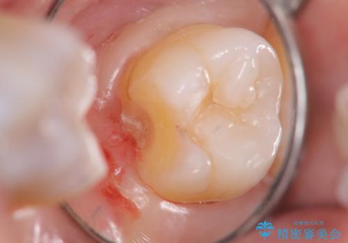 奥歯の深くて確認しにくい虫歯 ゴールドインレーでの治療の治療中