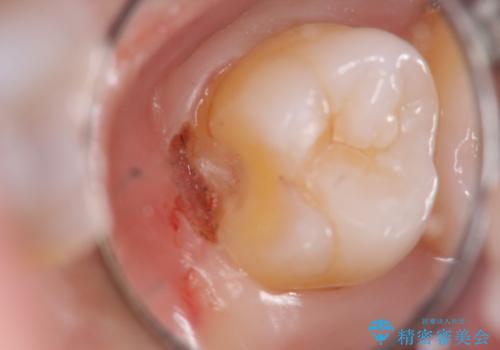 奥歯の深くて確認しにくい虫歯 ゴールドインレーでの治療の治療中