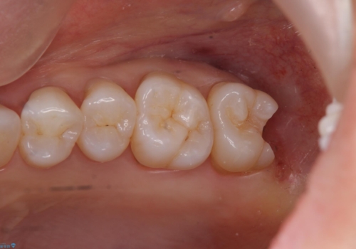 奥歯の深くて確認しにくい虫歯　ゴールドインレーでの治療の治療中