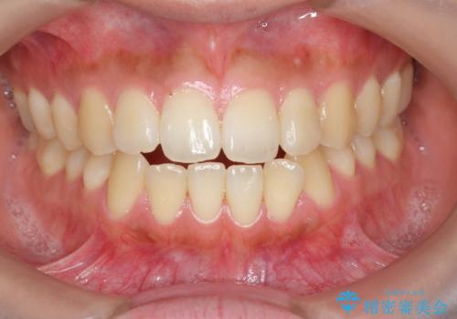 [ 前歯開咬 ]   前歯が噛んでいない マウスピース矯正治療の症例 治療前