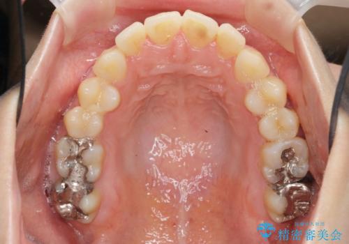 [ 前歯開咬 ]   前歯が噛んでいない マウスピース矯正治療の治療前