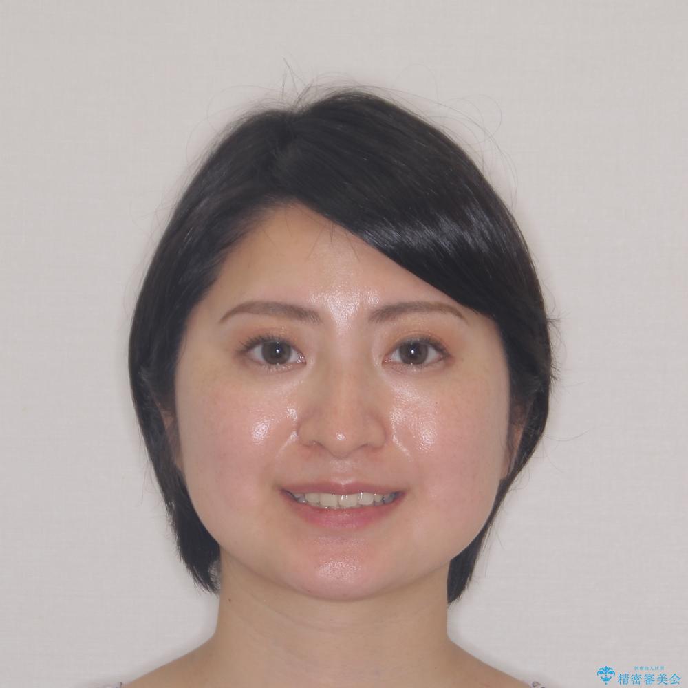 【モニター】インビザラインをしっかり使って短期間矯正治療の治療前(顔貌)