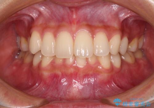 【モニター】インビザラインをしっかり使って短期間矯正治療の症例 治療前