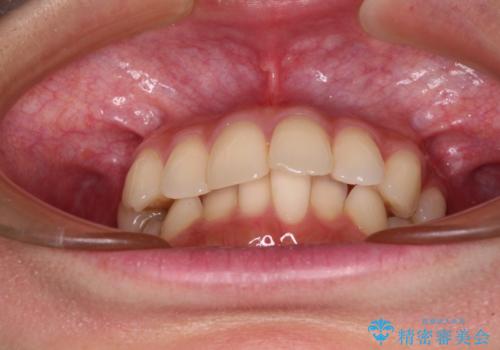 【モニター】インビザラインをしっかり使って短期間矯正治療の治療前