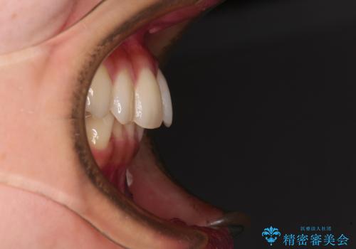 【モニター】インビザラインをしっかり使って短期間矯正治療の治療前