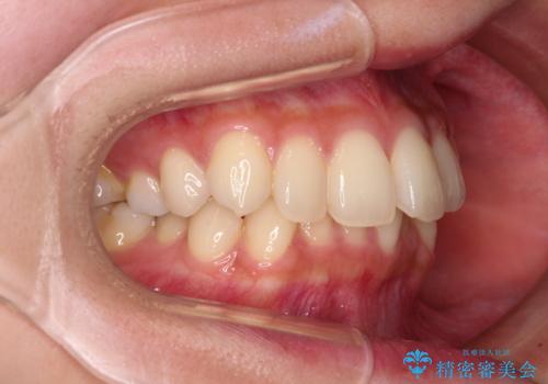 【モニター】インビザラインをしっかり使って短期間矯正治療の治療前