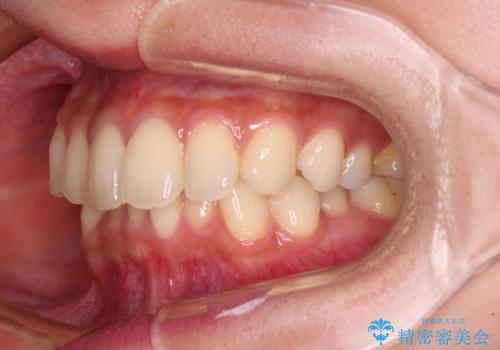 【モニター】インビザラインをしっかり使って短期間矯正治療の治療前
