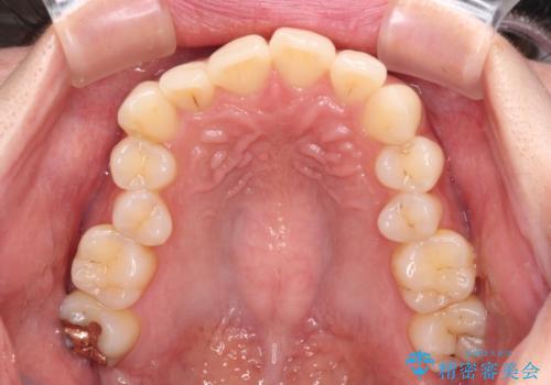 【モニター】インビザラインをしっかり使って短期間矯正治療の治療前