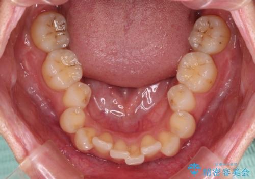 【モニター】インビザラインをしっかり使って短期間矯正治療の治療前