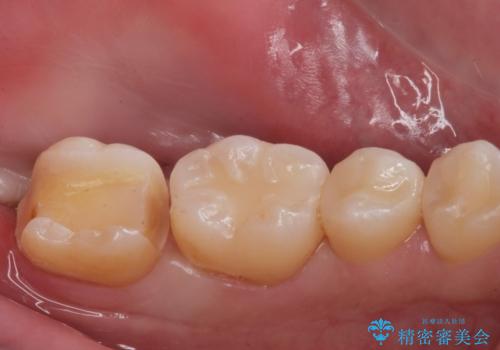 e-maxインレーによる治療の治療中