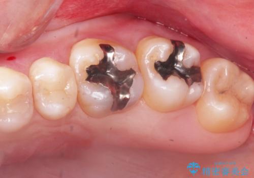 縁下歯石のクリーニングの症例 治療前