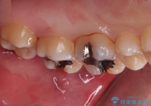 縁下歯石のクリーニングの治療前