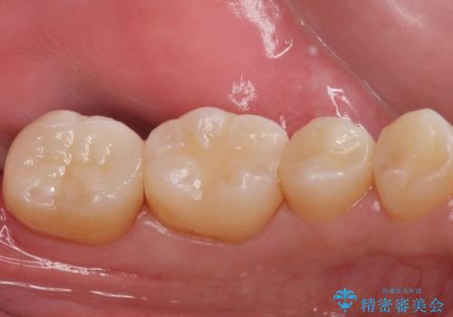 e-maxインレーによる治療の治療後