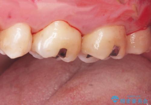 縁下歯石のクリーニングの治療前