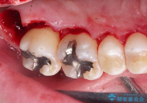 縁下歯石のクリーニングの治療中