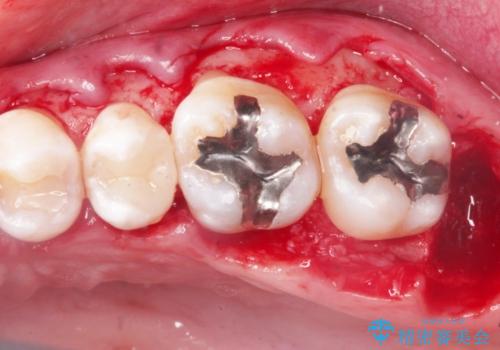 縁下歯石のクリーニングの治療中