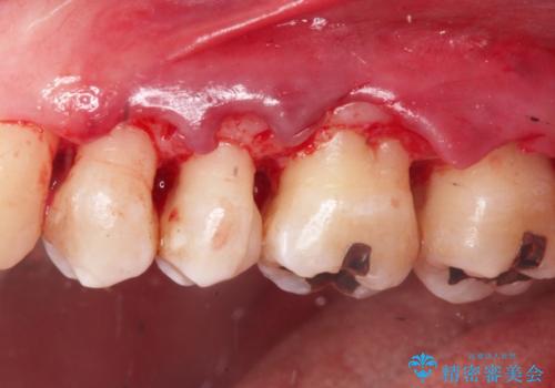 縁下歯石のクリーニングの治療中