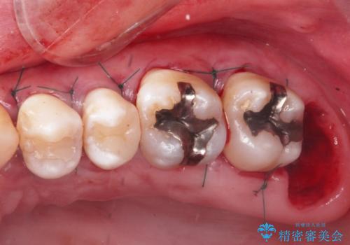 縁下歯石のクリーニングの症例 治療後