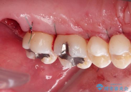 縁下歯石のクリーニングの治療後