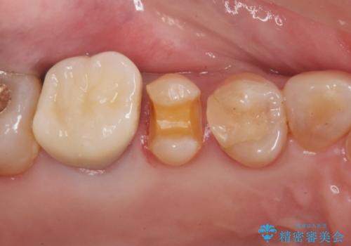 セラミックインレーのやりかえの治療中