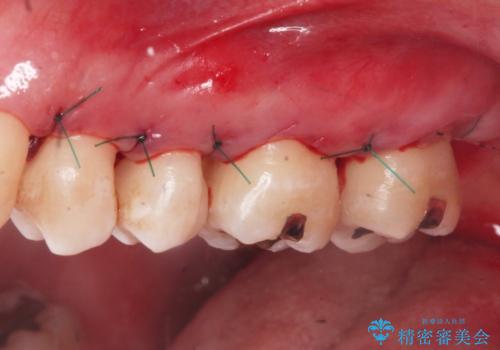 縁下歯石のクリーニングの治療後