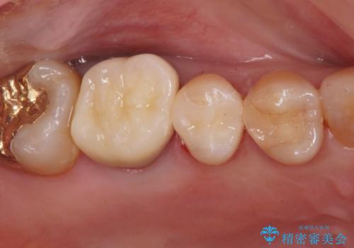 セラミックインレーのやりかえの症例 治療後