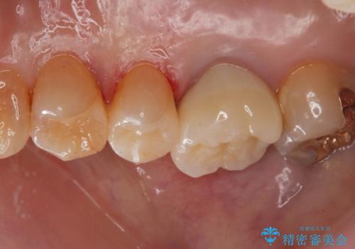 セラミックインレーのやりかえの治療後