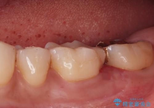 歯が黒くて虫歯じゃないかと心配して来院の治療後